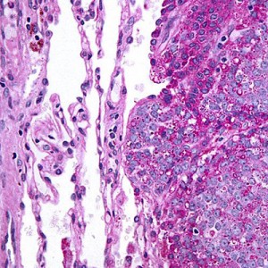 Ewing's Sarcoma cell