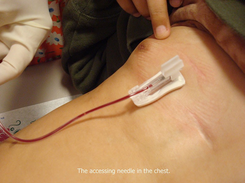 3accessedneedle